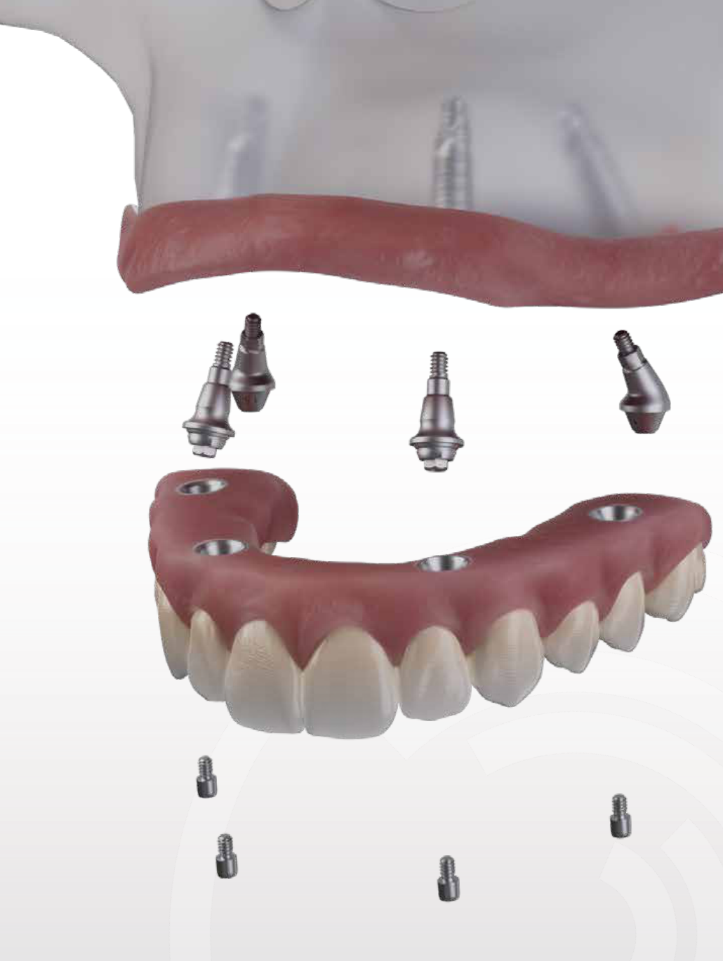 Exploded illustration showing how the All-on-4 bridge, multi-unit abutments and implant fixtures connect together